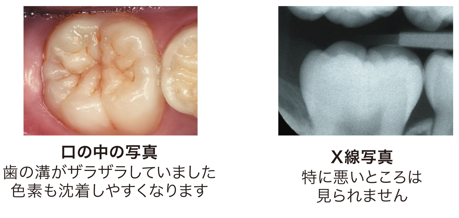 口の中の写真、歯の溝がザラザラしていました。色素も沈着しやすくなります。X線写真、特に悪い所は見られません。