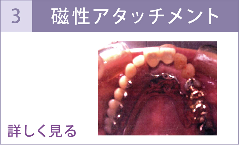 コーヌスデンチャー 審美義歯 | タスクデンタルクリニック