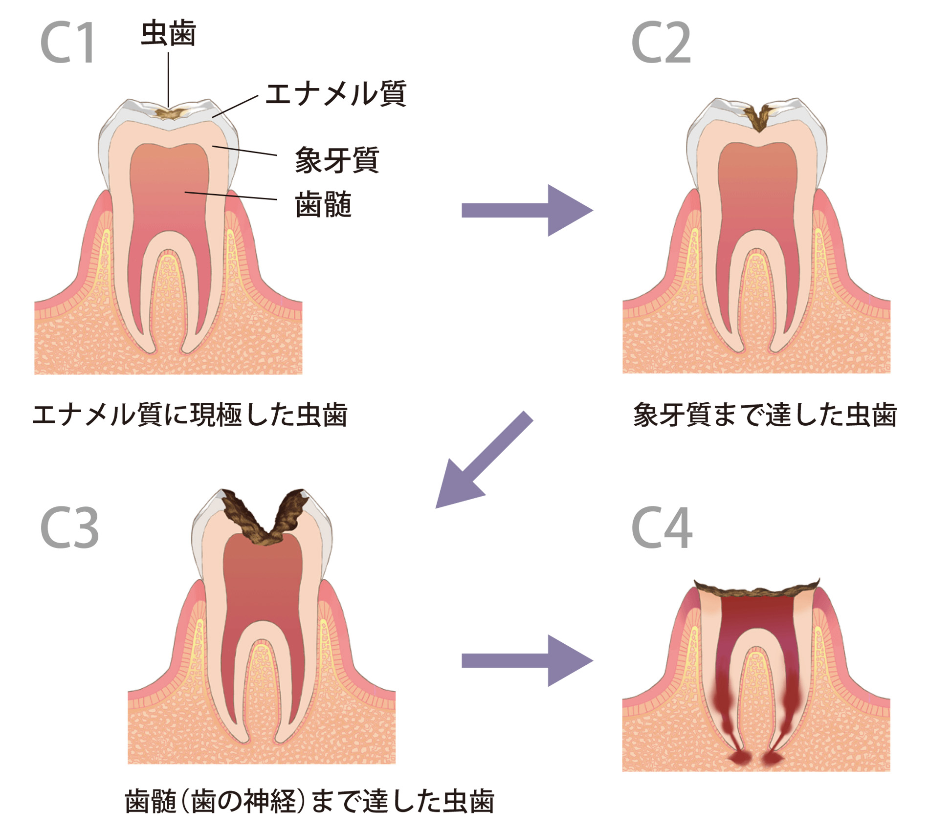 C1～C4までの分類図。C1:エナメル質に現極した虫歯。C2:象牙質まで達した虫歯。C3:歯髄（歯の神経）まで達した虫歯。