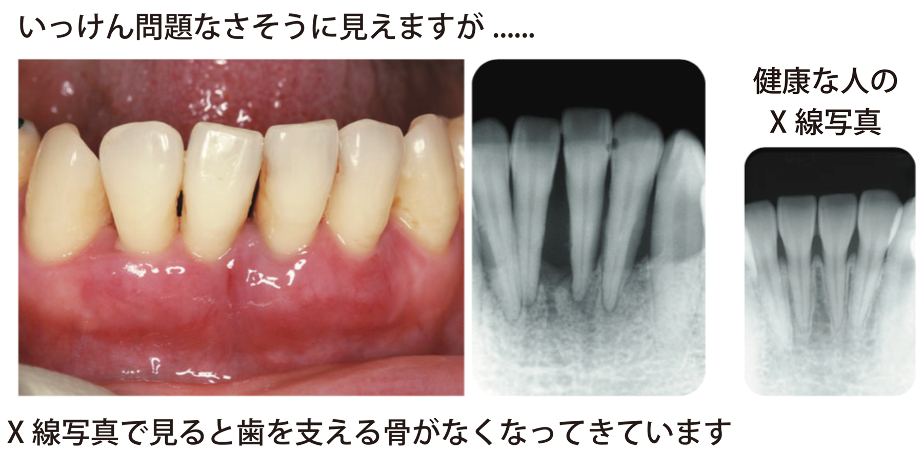 いっけん問題なさそうに見える歯でも、X線写真で見ると歯を支える骨がなくなってきています。