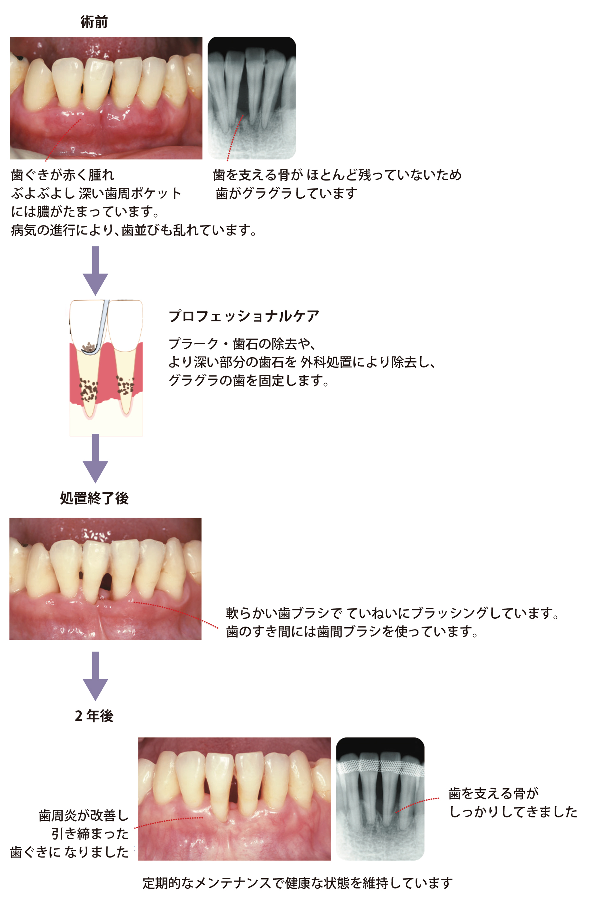歯ぐきが赤く腫れ、ぶよぶよし、深井歯周ポケットには膿が溜まっています。病気の進行により、歯並びも乱れています。歯を支える骨がほとんど残っていないため、歯がぐらぐらしています。そこで、プロフェッショナルケアにより、より深い部分の歯石を外科処置により除去し、グラグラの歯を固定ます。処置終了後にはやわらかい歯ブラシでていねいにブラッシングしています。歯の隙間には歯間ブラシを使っています。歯周炎が改善し、引き締まった歯ぐきになり、歯を支える骨がしっかりしてきます。定期的なメンテナンスで健康な状態を維持しています。