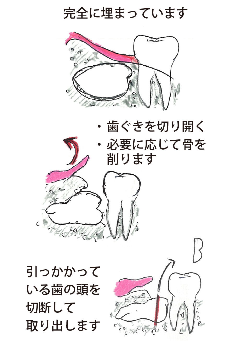 親知らず 糸 食い込む