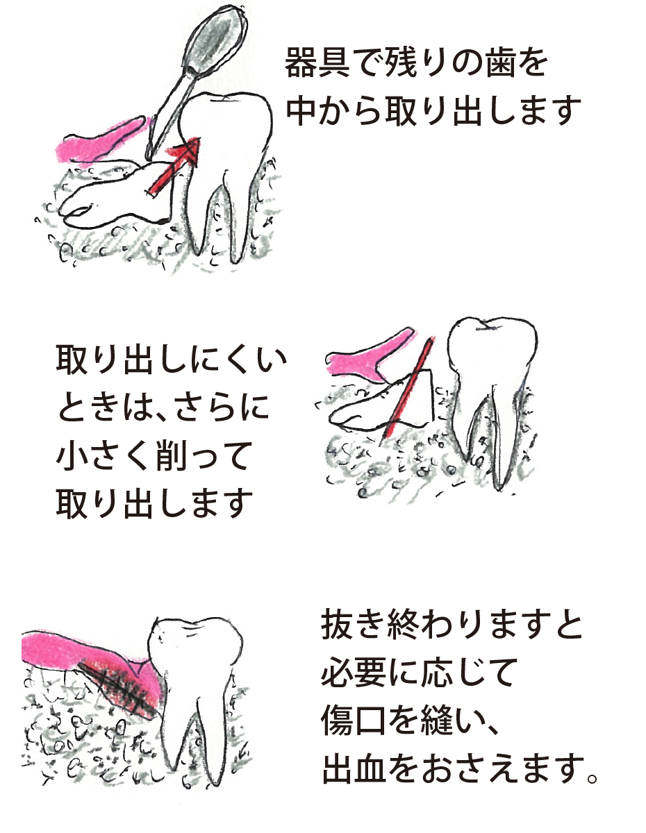 親知らず 糸 食い込む